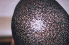 <ul><li><p><strong>Fungal Infection</strong>:</p><ul><li><p>Affects the scalp.</p></li><li><p>Patches of scaling with central hair loss.</p></li></ul></li></ul><p></p>