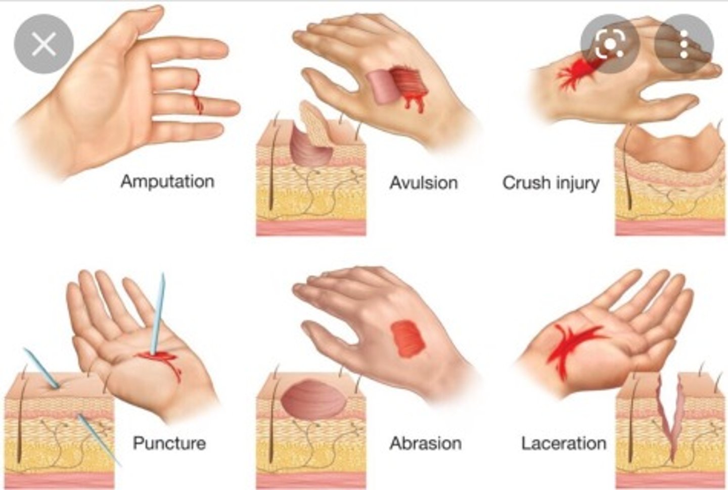<p>lacerations, abrasions, punctures, etc.</p>