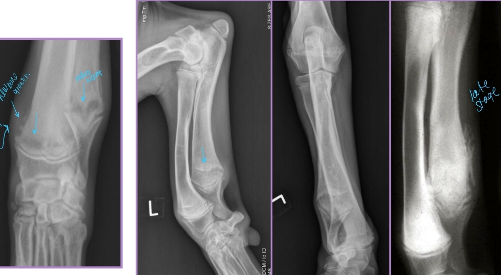<ul><li><p><span style="background-color: transparent;"><strong><span>AKA:</span></strong><span> </span><strong><span>Scurvy</span></strong><span>, Moeller-Barlow disease, Metaphyseal osteopathy, Osteodystrophy type I & II, </span><strong><span>Hypovitaminosis C</span></strong></span></p></li></ul><ul><li><p><span style="background-color: transparent;"><strong><span>Et: </span></strong></span><span style="background-color: transparent; color: red;"><span>Disease of long bones, especially distal metaphyses</span></span></p><ul><li><p><span style="background-color: transparent;"><span>Capillary loops become necrotic, vascular congestion, edema, metaplastic cartilage/bone</span></span></p></li><li><p><span style="background-color: transparent;"><strong><span>Forelimbs</span></strong><span> > hindlimbs</span></span></p></li></ul></li></ul><ul><li><p><span style="background-color: transparent;"><strong><span>Sig: </span></strong></span><span style="background-color: transparent; color: red;"><span>Juvenile large breed dogs, Rapid growth, <12 months</span></span></p></li></ul><ul><li><p><span style="background-color: transparent;"><strong><span>Cs:</span></strong><span> </span></span><span style="background-color: transparent; color: red;"><strong><span>Acute onset of lameness, Fever, Lethargy, Anorexia, Diarrhea, Pain at metaphyse</span></strong></span><span style="background-color: transparent;"><span>s, </span></span><span style="background-color: transparent; color: red;"><strong><span>Heat at metaphysis on all 4 limbs!!</span></strong></span></p></li><li><p><span style="background-color: transparent;"><strong><span>Dt: </span></strong><span>Radiographs</span></span></p><ul><li><p><span style="background-color: transparent;"><strong><span>Irregular, radiolucent line in metaphysis</span></strong><span> adjacent/parallel to physis (</span><u><span>“double physeal line”</span></u><span>)</span></span></p></li><li><p><span style="background-color: transparent;"><strong><span>Metaphyseal flaring + sclerosis</span></strong></span></p></li><li><p><span style="background-color: transparent;"><span>Subperiosteal and extraperiosteal </span><strong><span>new bone formation</span></strong></span></p></li></ul></li></ul><ul><li><p><span style="background-color: transparent;"><strong><span>Tx: </span></strong><span>Analgesics, antibiotics,</span><strong><u><span>self-limiting</span></u></strong></span></p></li></ul><p></p>