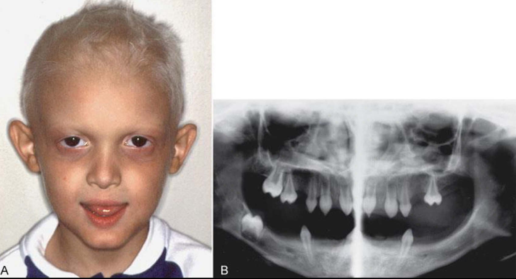 <p>Permanent dentition</p><p>Maxillary lateral incisors</p><p>Usually if temp teeth absent- permanent teeth won’t form</p><p>Associated with ectodermic dysplasia</p>