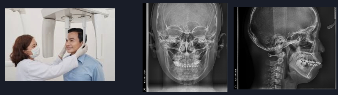 <p>Cephalometric X-rays </p>