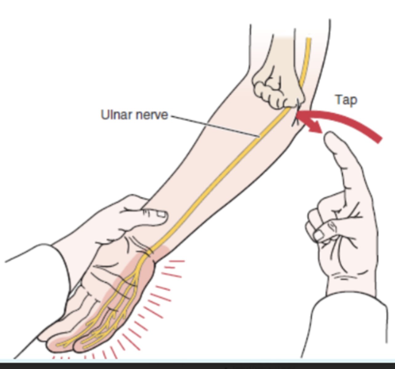 <p>- dysfunction of ulnar nerve at olecranon</p><p>(+): tingling sensation in ulnar distribution of forearm and hand distal to point of compression. The test indicates the point of regeneration of the sensory fibers of a nerve. The most distal point at which the patient feels the abnormal sensation represents the limit of nerve regeneration.</p>