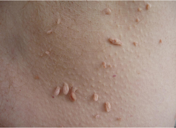 <p>Skin Tags (Acrochordons) </p>