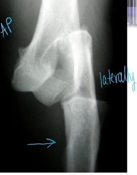 <p><span style="background-color: transparent;"><strong><span>Elbow Luxation</span></strong></span></p>