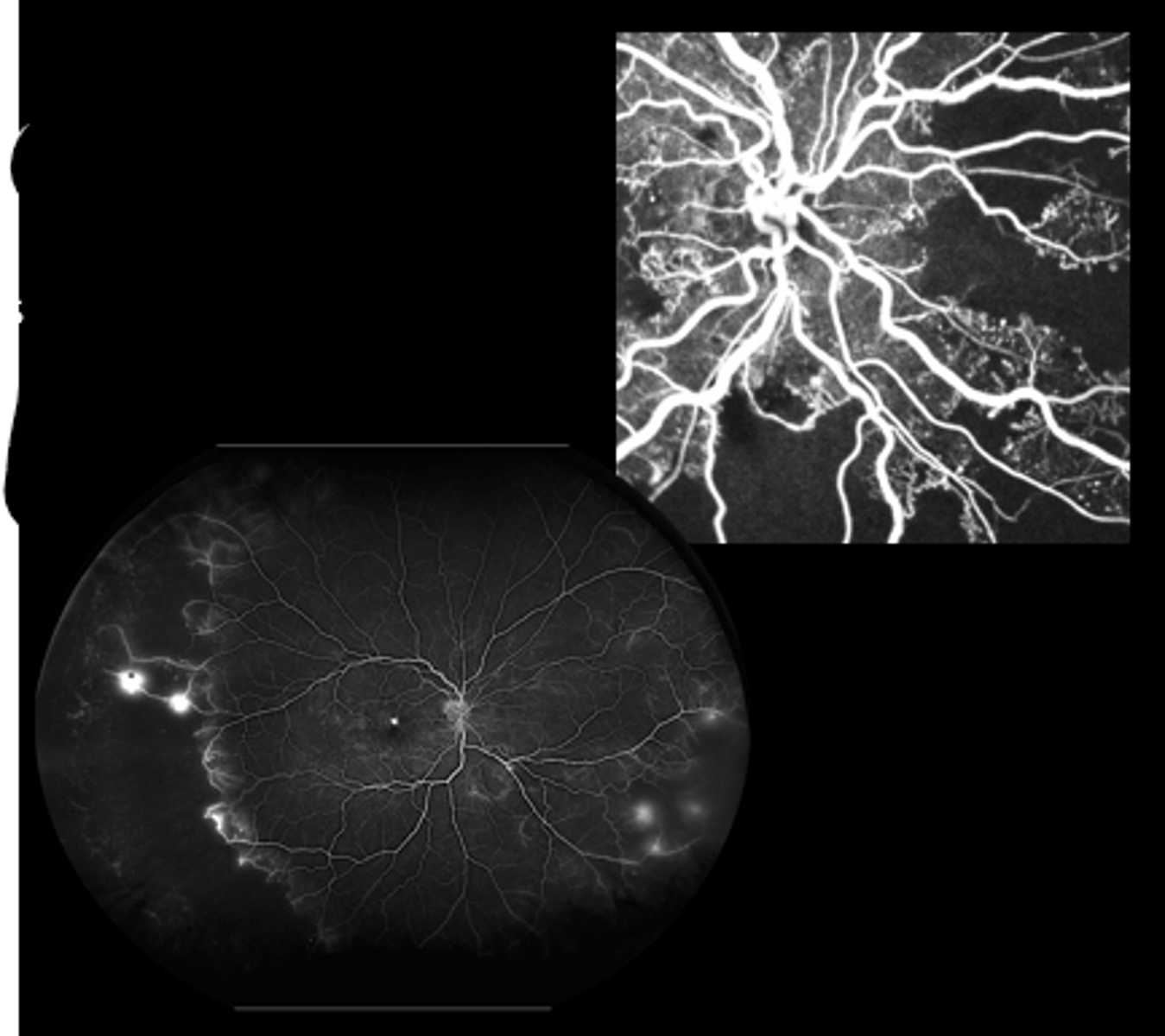 <p>When do we perform panretinal photocoagulation (PRP)?</p>