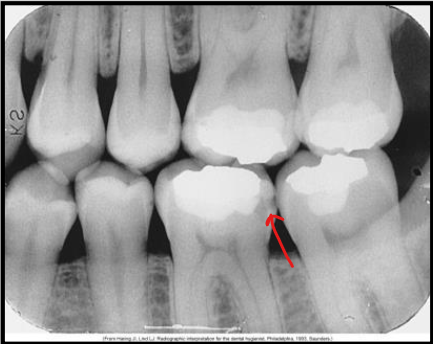 <p>What class of interproximal caries is this?</p>