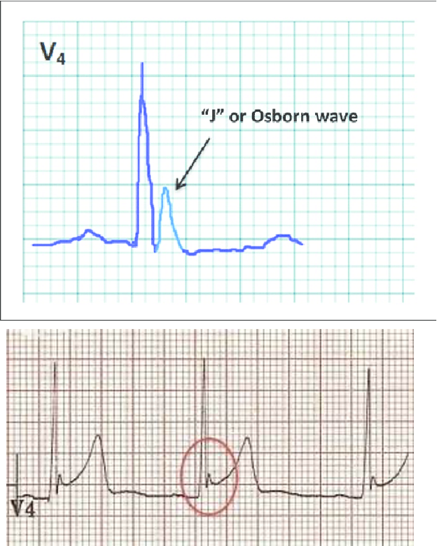 <p>normal variant ST segment elevation; mostly in young men</p><p>-global concave shaped ST seg elevation</p><p>-terminal QRS notching (J wave fishhook sign or Osborn wave)</p><p>-large T waves (sometimes symetrical)</p><p>-no reciprocal ST seg depression on ECG anywhere outside of aVR and V1</p>