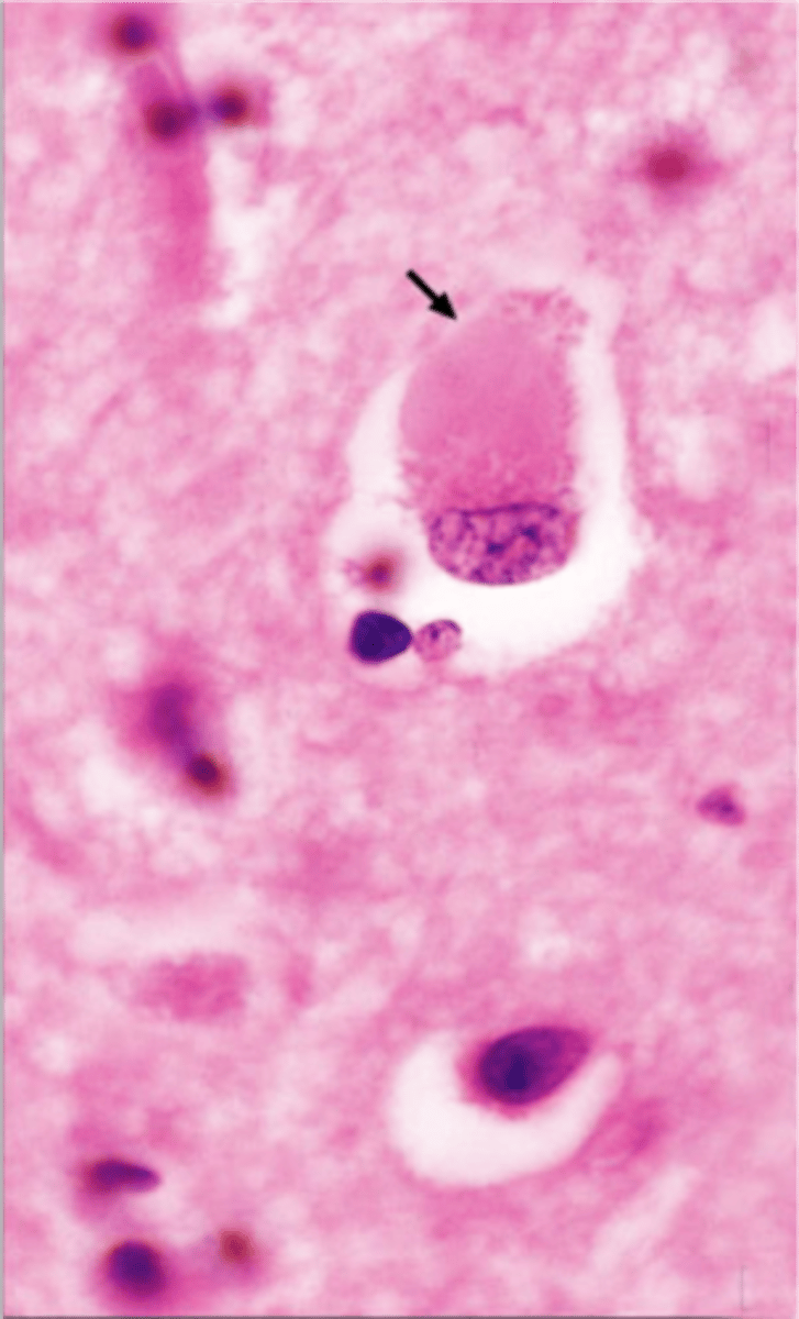 <p>Abnormal protein aggregations, presence of Lewy Bodies (alpha-synuclein neuronal inclusion bodies), similar to AD, includes: bradykinesia (slow motion) &amp; rigidity (similar to Parkinson's), recurrent and well-formed hallucinations, Memory deficits less severe than AD but visuospatial deficits are more severe than AD</p>