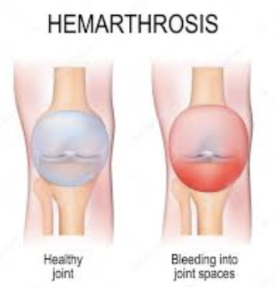 <p><code>Bleeding Disorder</code></p><ul><li><p>Includes several similar <strong>hereditary bleeding disorders </strong></p><ul><li><p><span style="color: green;"><strong>Hemophilia A </strong></span>→ most common type (77% of all cases) due to factor VIII deficiency </p></li></ul></li><li><p><strong>SYMPTOMS: </strong></p><ul><li><p>Prolonged bleeding, especially into joint cavities </p></li></ul></li></ul><p></p>