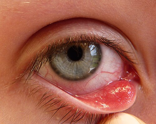 <p>PP/E: blocked meibomian gland→subacute/nontender+<strong>painless</strong> nodule</p><p>CM: points inside lid rather than on lid margin/outside lid</p>