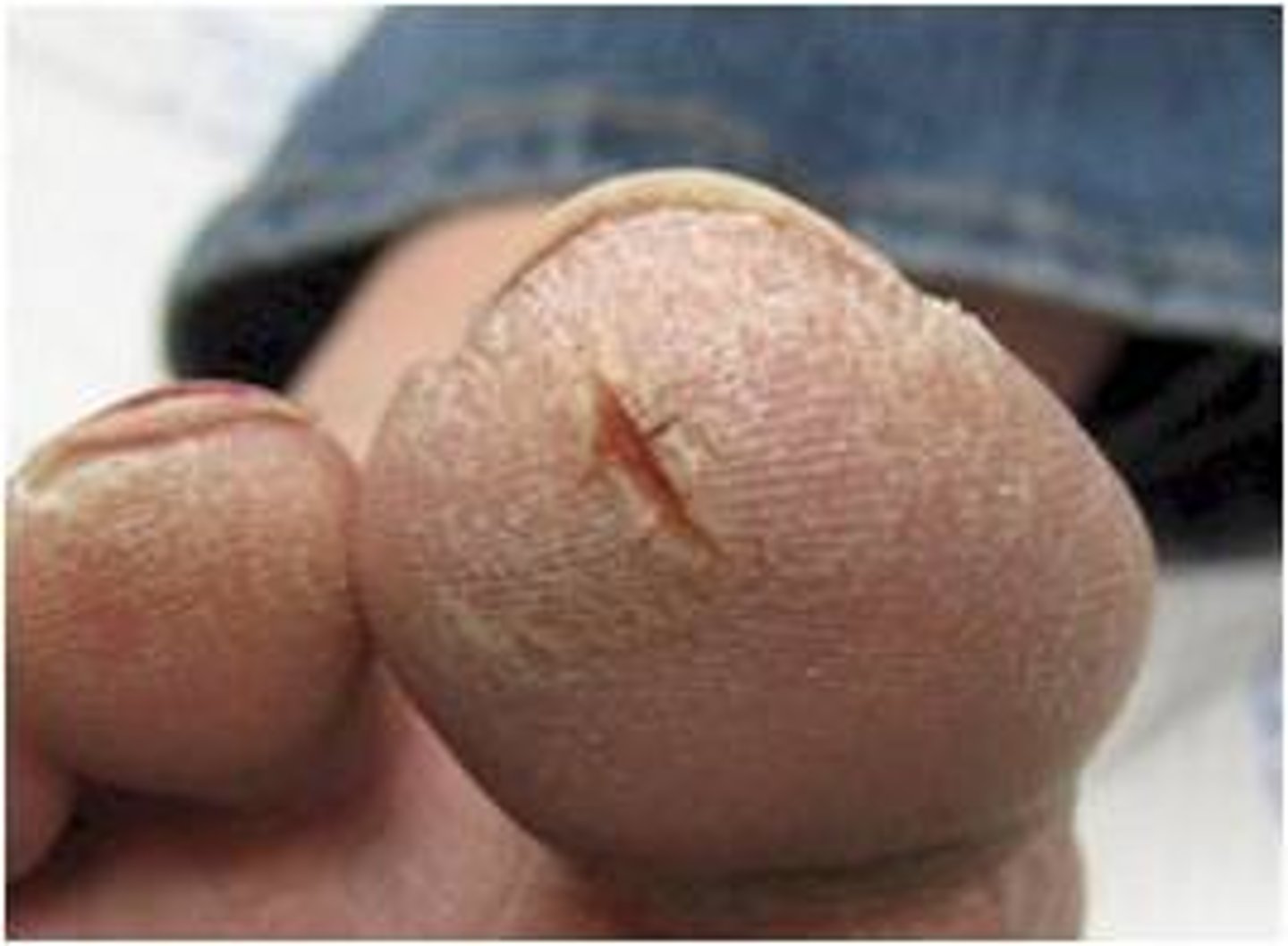 <p><b>secondary</b> <br><br>a linear crack in the skin, often resulting from excessive dryness<br><br>example: Athlete's foot</p>