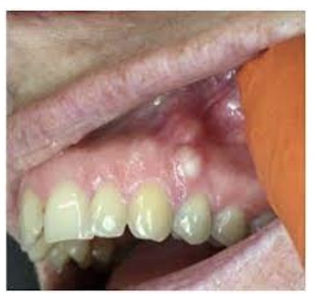 <p>Cyst most often seen in the mandibular cuspid and premolar area. An asymptomatic, unilocular or multilocular radiolucent lesion on the lateral surface of a tooth root. If its Intraosseous, it's called a ————— ——————— ————. If it's extraosseous, it's called a gingival cyst.</p>
