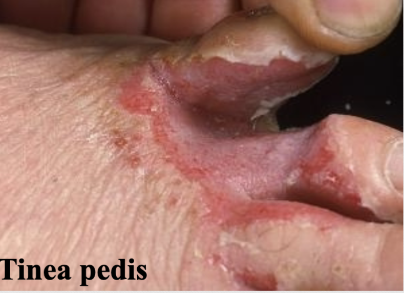 <p>ex. tinea pedis (athletes’ foot)</p>