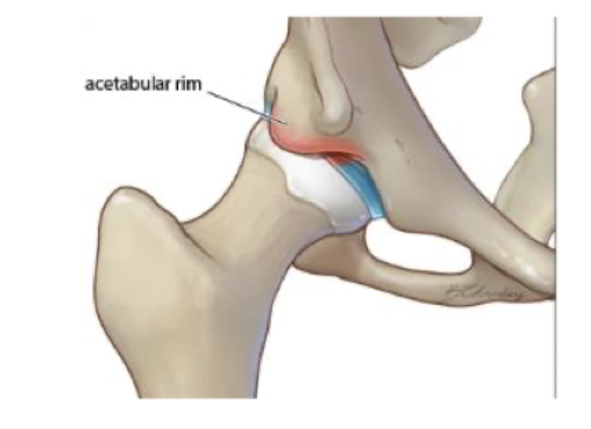 <p>What type of FAI is characterized by excess bone growth on the acetabulum that leads causing “over coverage” of the acetabulum - active middle aged women</p>