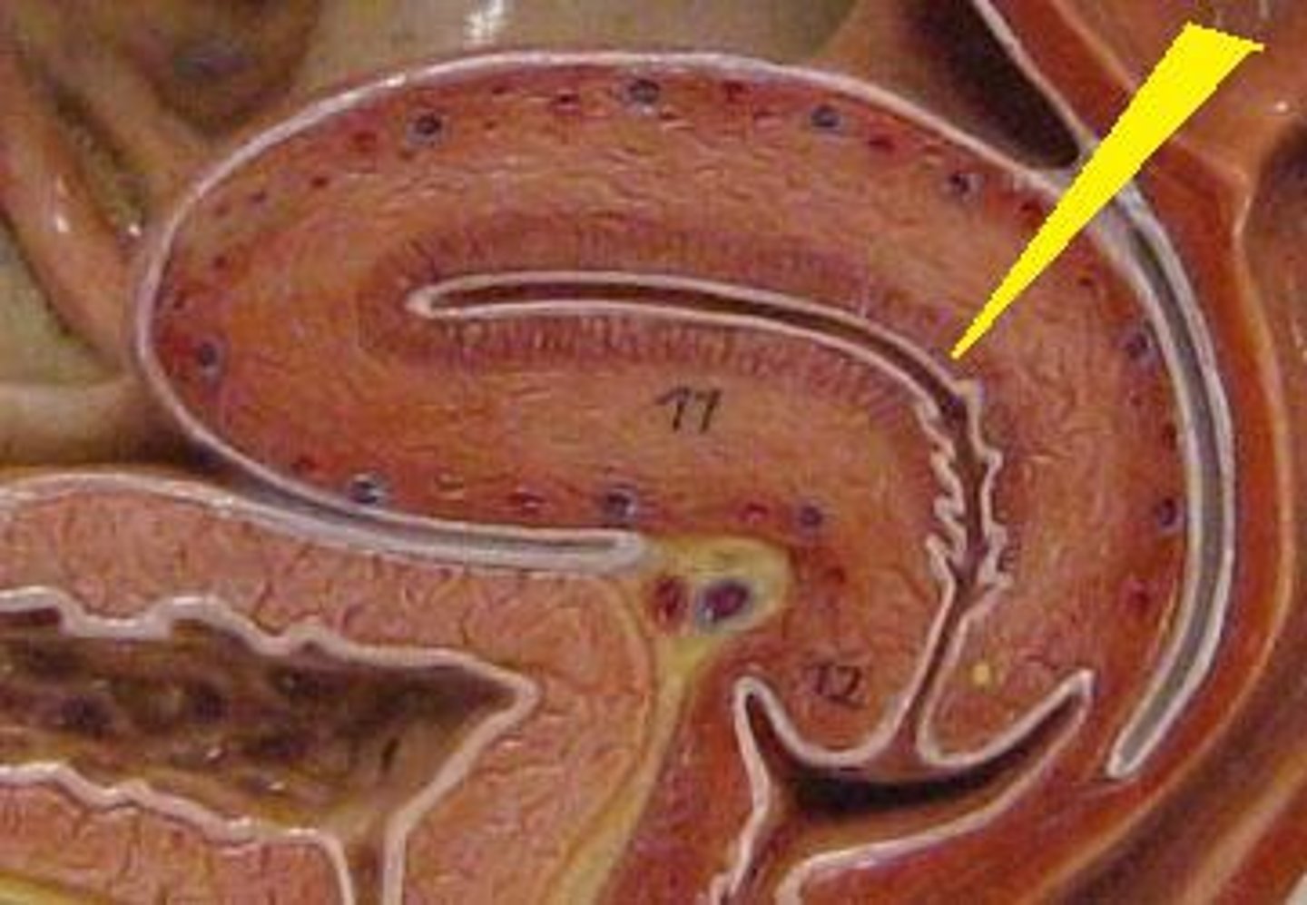 <p>(deep)</p><p>-simple columnar epithelium with thick layer of c.t. containing glands, vessels and leukocytes</p>