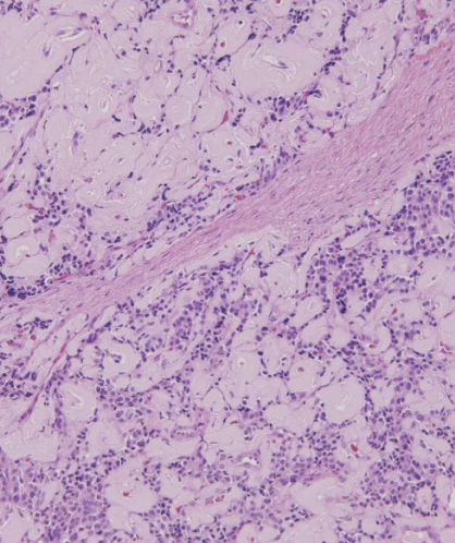 <p>enlarged islets, without disruption of normal architexture and no evidence of anaplasia (even if malignant); amyloid deposition extracellularly is often seen</p>