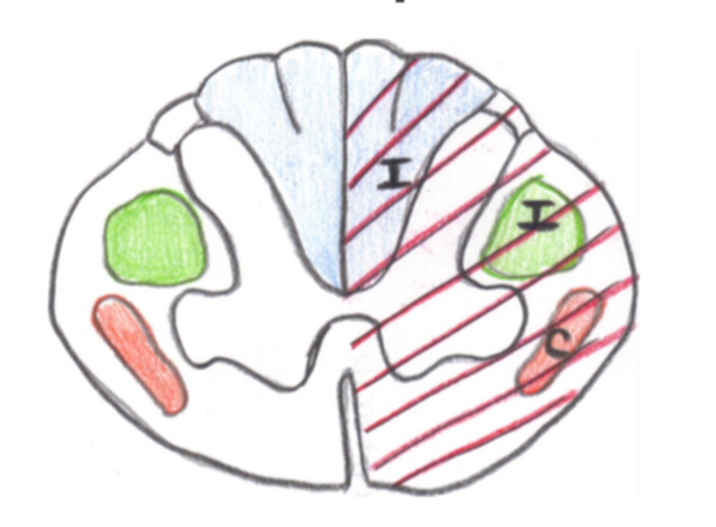 <p>This image depicts the damage associated with which Incomplete SCI Syndrome?</p>