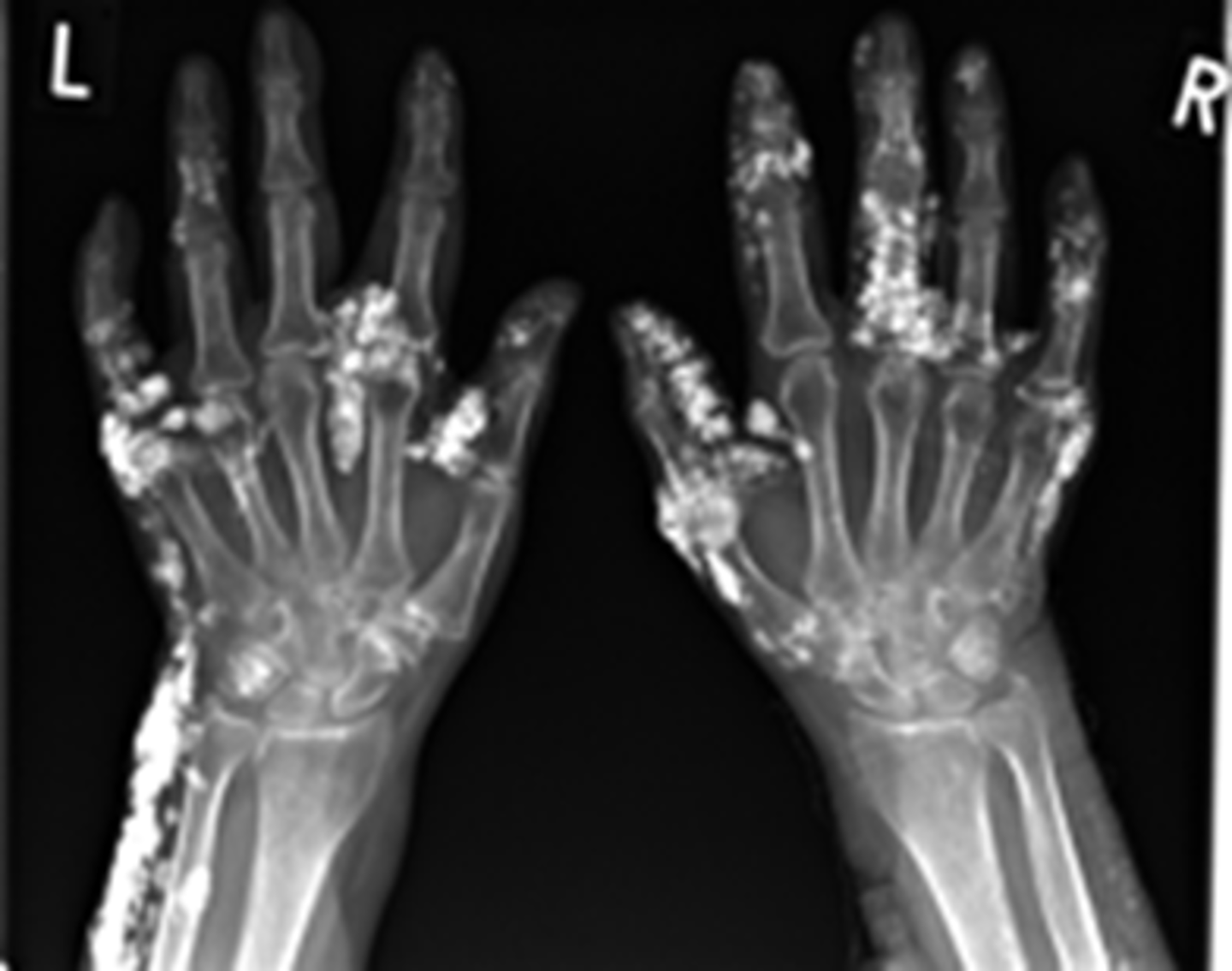 <p>increased bone density</p><p>cutaneous calcifications</p>