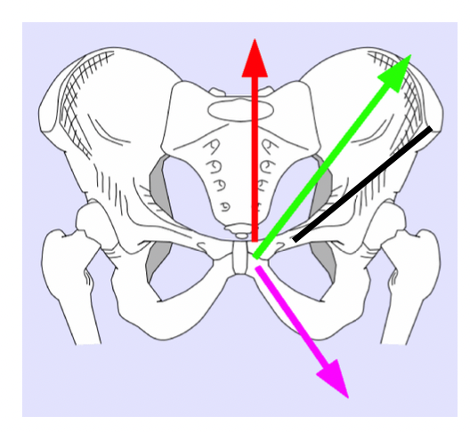 <ul><li><p>MOI: Twisting w foot planted: sudden change of directions</p></li><li><p>S/S: nagging deep groin pain, pain w hip flexion, valsalva</p></li><li><p>Imaging: MRI, Treatment: conservative or surgical</p></li><li><p>Hard to determine source of problem</p><ul><li><p>Oblique's (green)</p></li><li><p>Rectus abdominus (red)</p></li><li><p>Inguinal ligament and canal (black)</p></li><li><p>Adductor muscles (violet)</p></li></ul></li></ul><p></p>