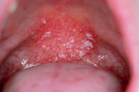<p>Case 1. A 42-year-old male is asthmatic and presents with diffuse white plaques on the palate. 1a. What is the first thing you would do?</p>
