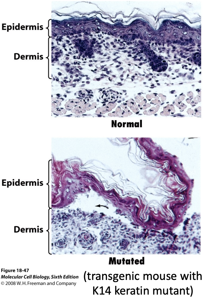 \
* Genes encoding IFs are associated with >40 clinical disorders. 
* The genetic disease epidermolysis bullosa simplex (EBS) is caused by mutations in keratin genes expressed in skin. The skin of people with this disease is very sensitive to injury. 
* More than 50 different mutations in type-A lamins cause disease, including Emerey-Dreifuss muscular dystrophy (EDMD), cardiomyopathy, and progeria (premature aging).