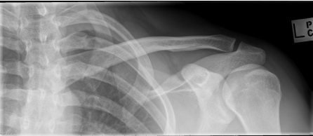 <p><strong>Clavicle Fractures</strong></p><p>-Image with _ views</p><p>-Divided into ______ → distal, midshaft, and proximal </p><p>-MC in kids and young adults</p><p>-MOI → FOOSH or direct blow</p>