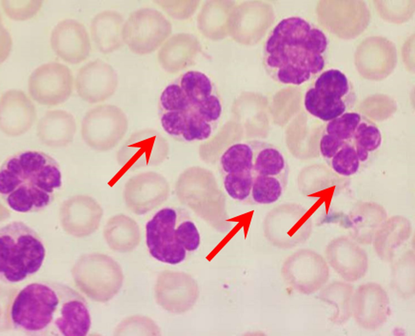 <p>cancers from blood-forming cells</p>