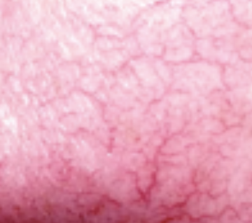 <p>Vascular Skin Lesion</p><ul><li><p><strong>Dilated arterioles</strong></p></li><li><p>Common to patients with <strong>liver problems, Vitamin B deficiency, and pregnant clients</strong></p></li><li><p>Usually in <strong>abdomen </strong>or <strong>cheeks</strong></p></li></ul><p></p>