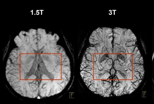 <p>3 T Imaging uses a magnetic field strength of 3 Tesla and is high resolution imaging. </p><p><strong>Pros</strong></p><ul><li><p>has more signal </p></li><li><p>decreased scan time </p></li></ul><p><strong>Cons</strong></p><ul><li><p>More chance of burns and projectiles </p></li><li><p>Harder for patients to thermoregulate so increased movement </p></li></ul><p></p>