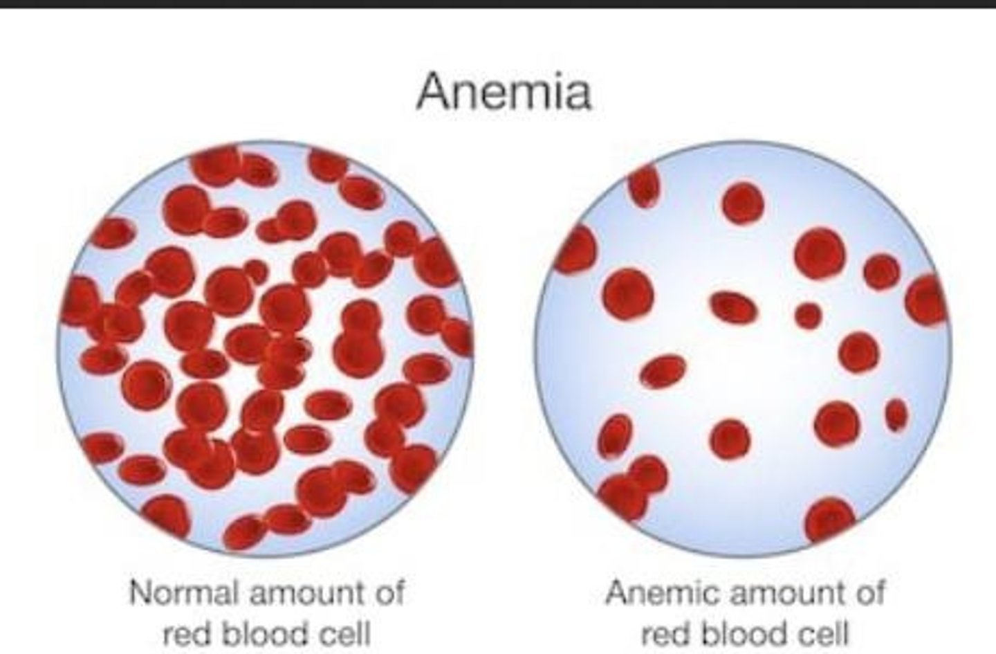 <p>Condition of low red blood cell count.</p>