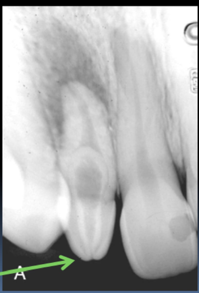 <p>"Tooth within a tooth"</p><p>-Invagination of the crown or root that is lined with enamel</p><p>-Most common-maxillary lateral incisor; accentuation of the lingual pit.</p>