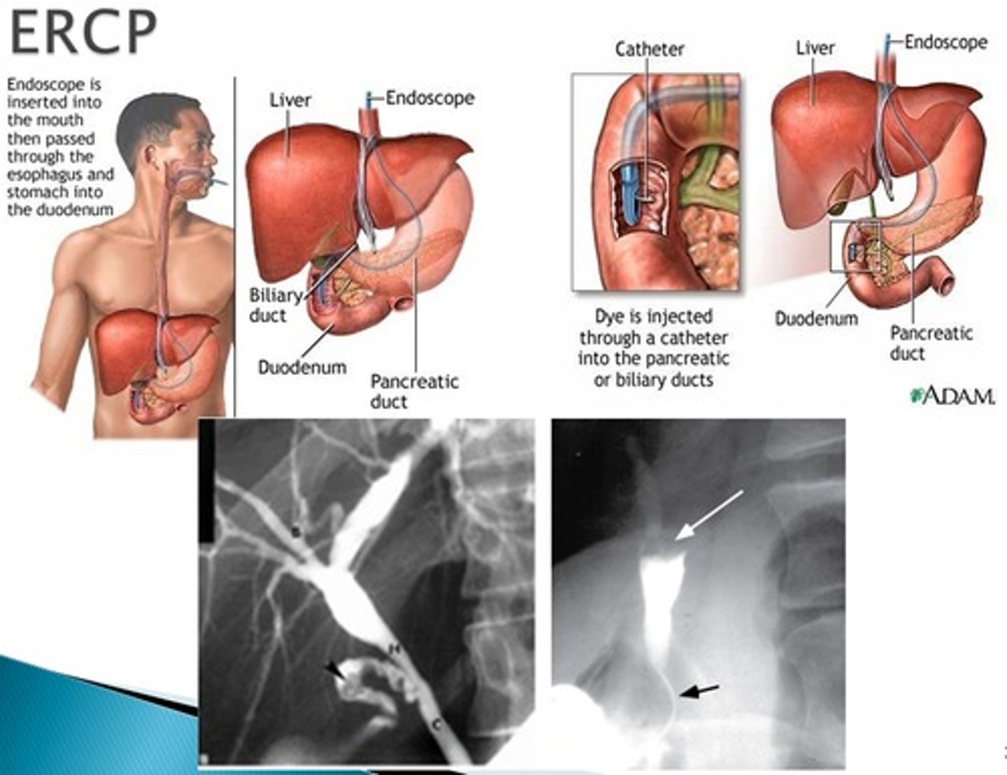 <p>ERCP used diagnosis and treatment</p><p>MRCP is only used for diagnosis (perfered bc it has a small mortality rate)</p><p>NPO</p><p>Consent is required</p>