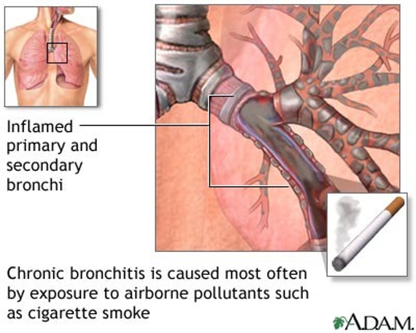 <p>inflammation of bronchi persisting over a long time; type of chronic obstructive pulmonary disease (COPD)</p>