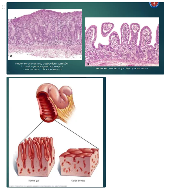 <ul><li><p>zaburzenie trawienia i wchłaniania jelitowego w konsekwencji wzmożonej odpowiedzi immunologicznej na spożywane i zawarte w glutenie białka:</p><ul><li><p>gliadynę (pszenica)</p></li><li><p>sekalinę (żyto)</p></li><li><p>hordeinę (jęczmień)</p></li><li><p>aweninę (owies)</p></li></ul></li><li><p>objawy:</p><ul><li><p>kurczenie jelitowe</p></li><li><p>bóle brzucha</p></li><li><p>przewlekła biegunka osmotyczna</p></li><li><p>stolce obfite, cuchnące, tłuszczowe (wodniste, fermentacyjne)</p></li><li><p>NIEDOŻYWIENIE!! → następstwa zaburzenia wchłaniania jelitowego:</p><ul><li><p>niski wzrost</p></li><li><p>osteoporoza</p></li><li><p>niedokrwistość niedobarwliwa</p></li><li><p>opóźnione pokwitanie</p></li><li><p>zaburzenia uwagi, drażliwość, męczliwość</p></li></ul></li></ul></li><li><p>postacie choroby:</p><ul><li><p>klasyczna → jawna</p><ul><li><p>pełnoobjawowa, aktywna</p></li><li><p>występuje u ok. 30% przypadków</p><ul><li><p>bóle brzucha</p></li><li><p>wzdęcia</p></li><li><p>biegunki tłuszczowe lub wodniste</p></li><li><p>objawy niedoborowe składników pokarmowych (m. in. anemia)</p></li><li><p>spadek masy ciała</p></li><li><p>zaburzenia rozwoju u dzieci (np. niskorosłość)</p></li><li><p>zmiany w zachowaniu (np. depresja)</p></li></ul></li></ul></li><li><p>niema → ubogoobjawowa</p><ul><li><p>występują typowe zmiany w błonie śluzowej jelita, nie występują jednak objawy choroby aktywnej</p></li><li><p>może się pojawić:</p><ul><li><p>niedokrwistość</p></li><li><p>próchnica zębów, niedorozwój szkliwa zębowego</p></li><li><p>nawrotowe afty i wrzodziejące zapalenia jamy ustnej</p></li><li><p>podwyższony poziom cholesterolu</p></li><li><p>zaburzenia neurologiczne (ataksja, neuropatia obwodowa)</p></li><li><p>otępienie, schizofrenia, upośledzenie umysłowe</p></li><li><p>ch. Duhrinda (glutenozależne opryszczkowe zapalenie skóry</p></li><li><p>wczesna osteoporoza</p></li><li><p>nawykowe poronienia</p></li></ul></li></ul></li><li><p>postać ukryta → latentna</p><ul><li><p>występowanie przeciwciał IgA EMA u osób z prawidłowym wynikiem biopsji jelita cienkiego</p></li></ul></li></ul></li></ul><p></p>