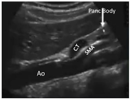 <p>Black = Pancreatic body</p><p>Blue = SMA</p><p>Red = Celiac trunk</p><p>Yellow = Aorta</p>