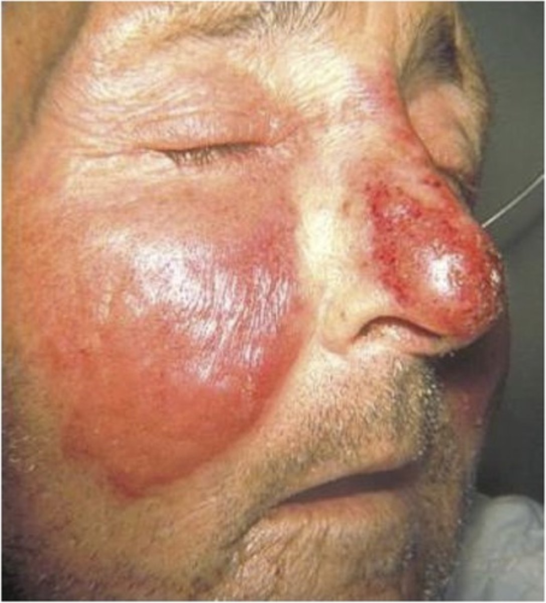 <p>-caused by group A strep</p><p>-goes partially through dermis</p><p>-well-demarcated borders</p><p>-affects children + adults</p><p>-red skin</p><p>-antibiotics for treatment</p>