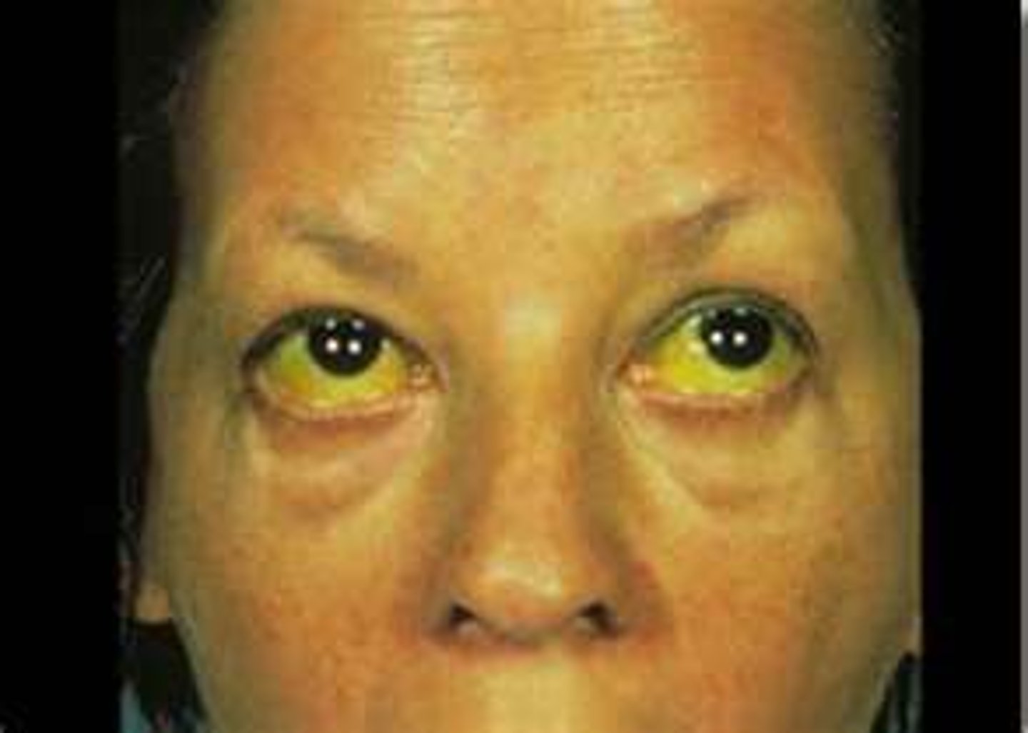 <p>yellow discoloration of sclera, skin, and mucous membranes</p><p>associated with excessive levels of bilirubin</p>