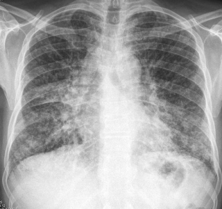 <p>90% will show abnormal chest x-ray</p>