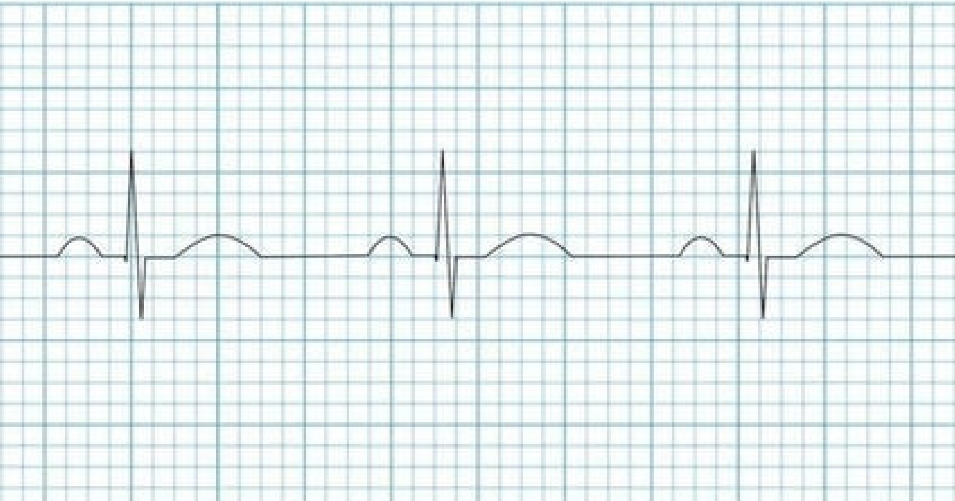 <ul><li><p>Intrinsic rate of 60 to 100 beats/minute</p></li><li><p class="has-focus">Regular, with minimal variation between RR intervals</p></li><li><p>P wave is present, upright, and precedes each QRS complex (<100ms wide)</p></li><li><p>Constant PR Interval</p></li></ul><p></p>