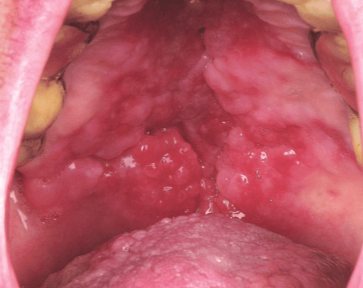 <p>Erytematösa områden, diskoida lesioner och ödem</p>