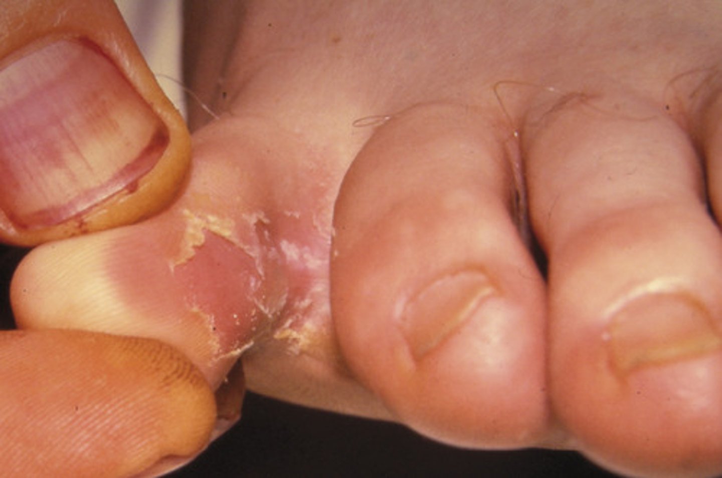 <p>Informally known as tineas or ringworm</p><p>Tinea capitis: scalp ringworm</p><p>Tinea pedis: athlete's foot</p>
