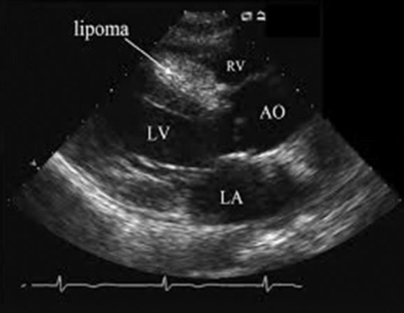 <p>Traits of Lipomas</p>