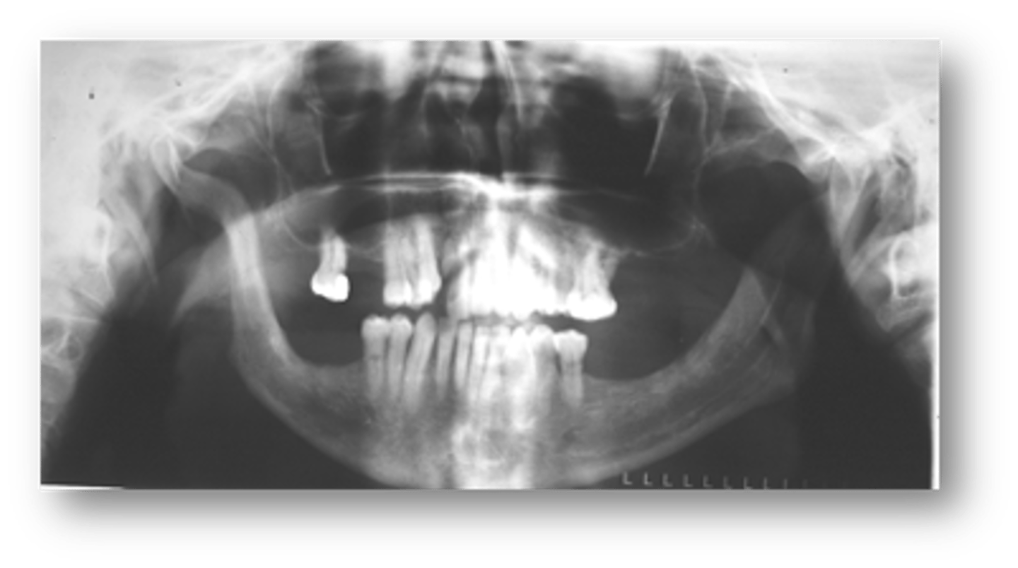 <p>patient's radiograph shows the following features:</p><p>-Mandibular erosions at regions of muscle attachments: angles, coronoid process, condyles</p><p>- Decreased mouth opening</p><p>- Xerostomia</p><p>- Uniform widening of PDL space around the teeth</p><p>- Deep periodontal pockets</p><p>- Increased number of decayed, missing / filled teeth</p><p>What is the diagnosis?</p>