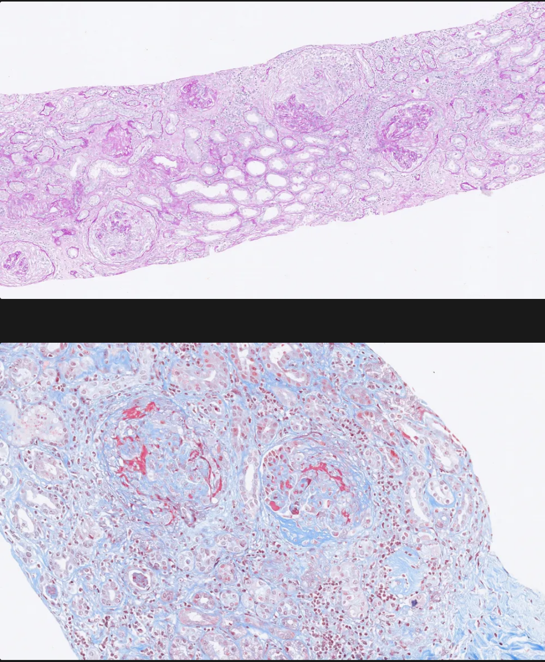 <p>Qué se aprecia en la imágen y a que patologia está asociada?</p>