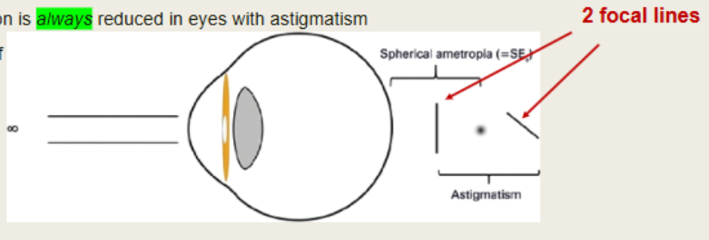 <p>astigmatism </p>