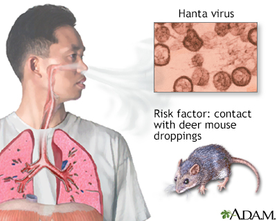 <p>Viruses carried by rodents (like mice and rats). People can get infected by breathing in dust contaminated with rodent urine, droppings, or saliva. </p><p>Hantaviruses can cause serious diseases like <strong>Hantavirus Pulmonary Syndrome</strong> or <strong>Hemorrhagic Fever with Renal Syndrome</strong></p>