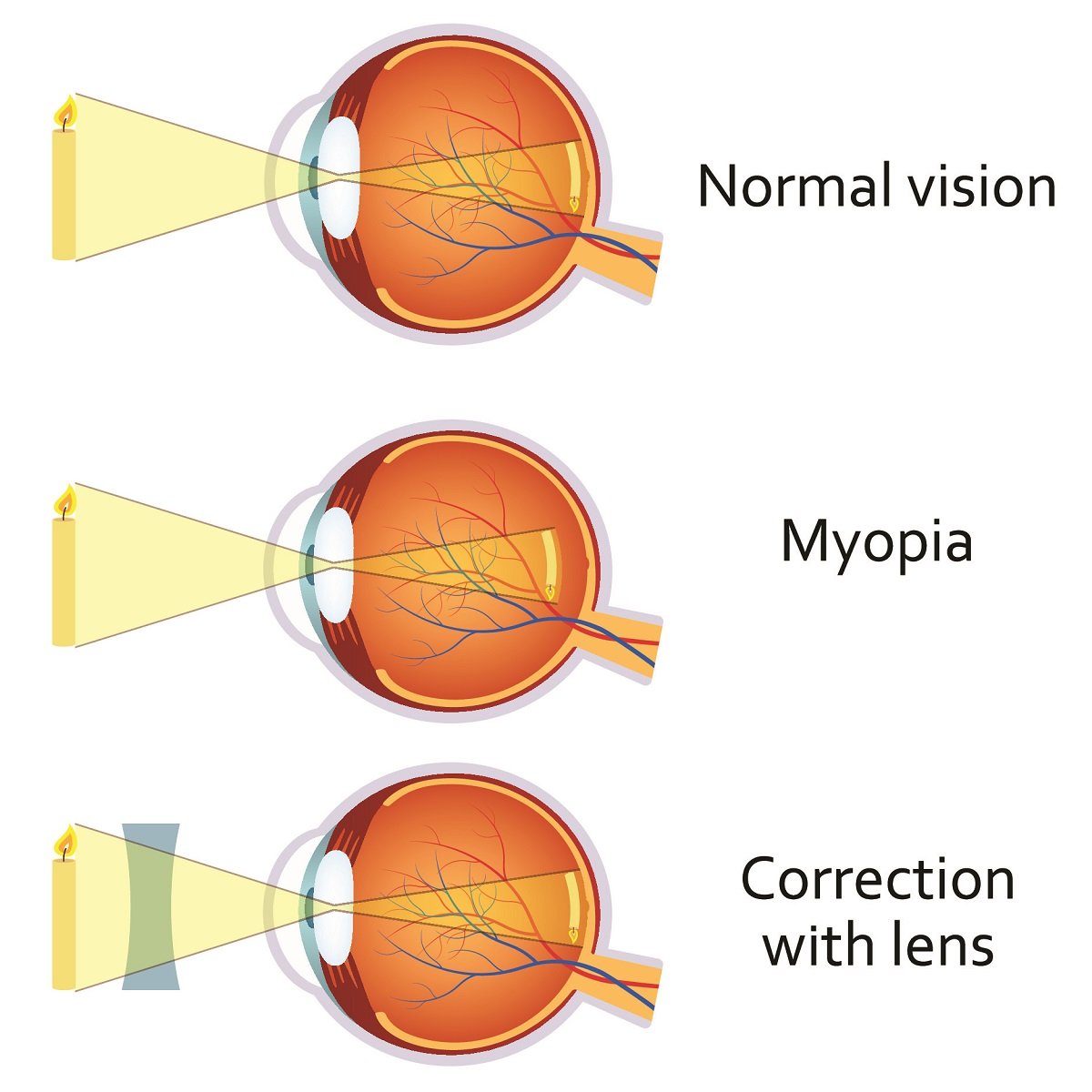 nearsighted

eyeball too long

focal point is in front of retina