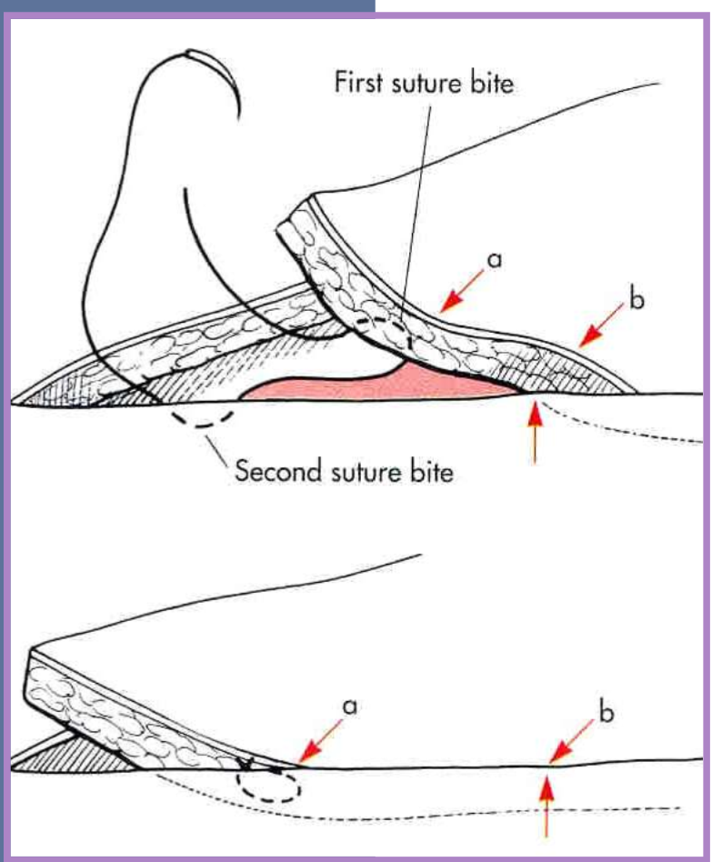 <ul><li><p>must do undermining first </p></li><li><p>moves skin across a defect </p></li><li><p>obliterates dead space </p></li><li><p>distributes tension over the wound surface </p><ul><li><p>via several suture rows </p></li><li><p>less chance of dehiscence of main incision closure </p></li></ul></li><li><p>stretches skin in small increments </p></li><li><p>anchored in <strong>fascia and dermis </strong></p><ul><li><p><strong>do not penetrate the skin surface </strong></p></li></ul></li></ul><p></p>