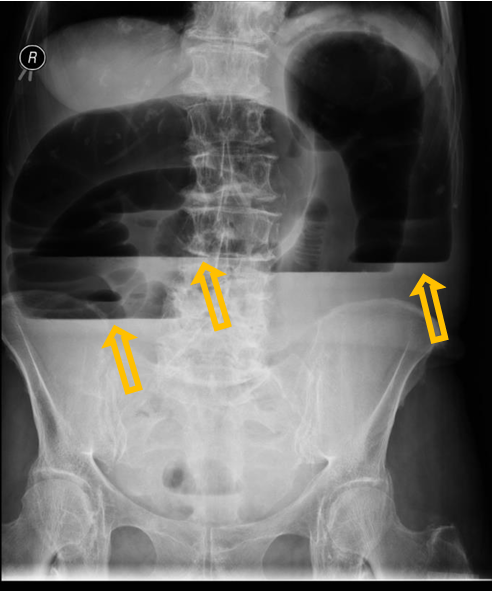 <p>Patient history: pelvic tumor in history, at present severe abdominal pain and cramping in an elderly female patient </p><p>Modality: abdominal radiograph, erect position </p><p>Region: abdomen and pelvis Radiologic sign: Distended, meteoristic ascending, transverse and descending colon with several large air-fluid levels up to 10-15 cm in diameter (yellow arrows). Small bowels containing less gas than normal, few non distented jejunum loops visible epigastically. </p><p>Diagnosis: mechanical large intestine ileus caused by ovarial cancer infiltrating the sigmoid colon</p>