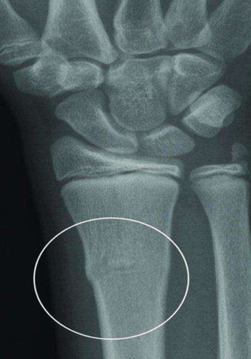 <p>What type of fracture is this?</p>